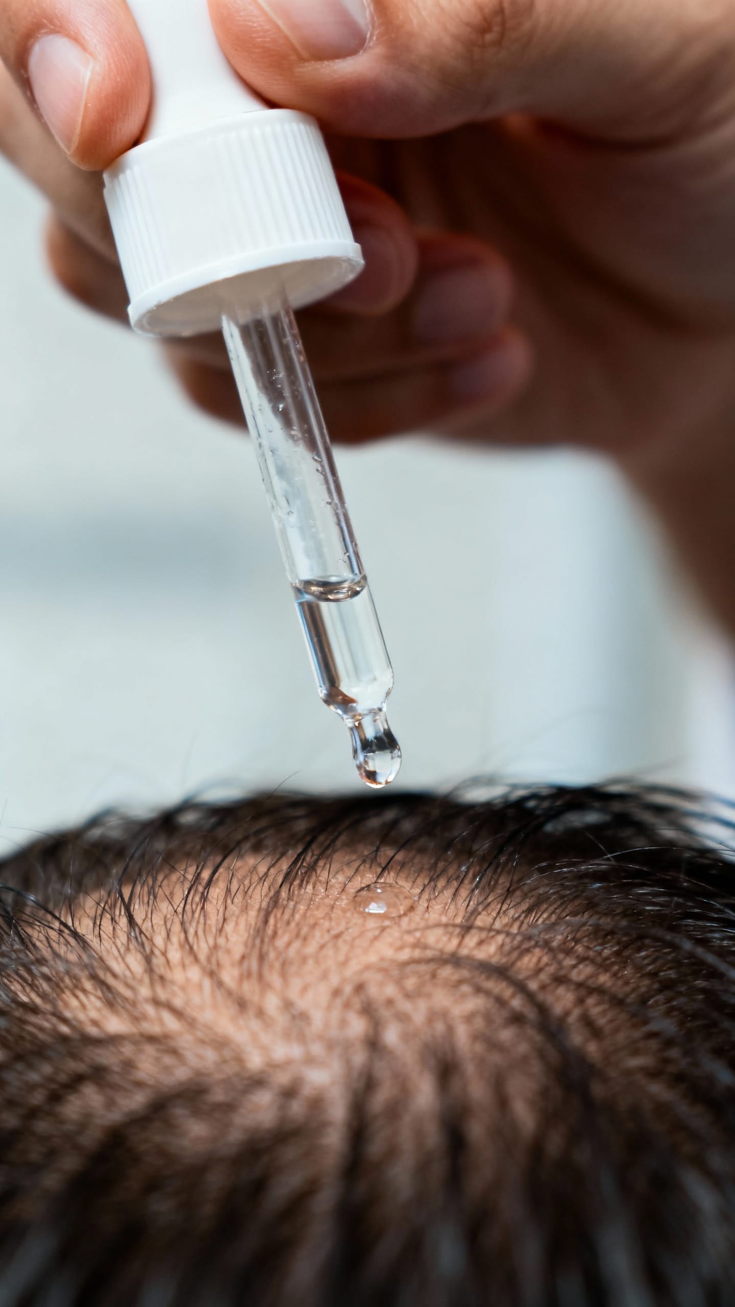 Closeup hand applying minoxidil dropper to scalp, clear liquid