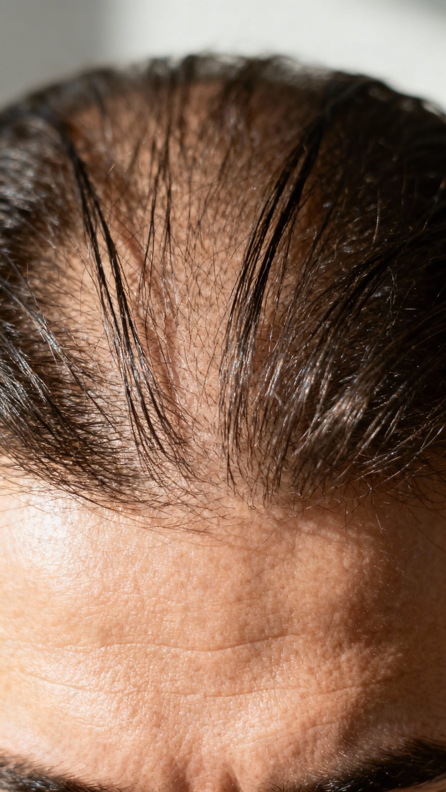 Closeup male scalp crown thinning, parted hair, natural light